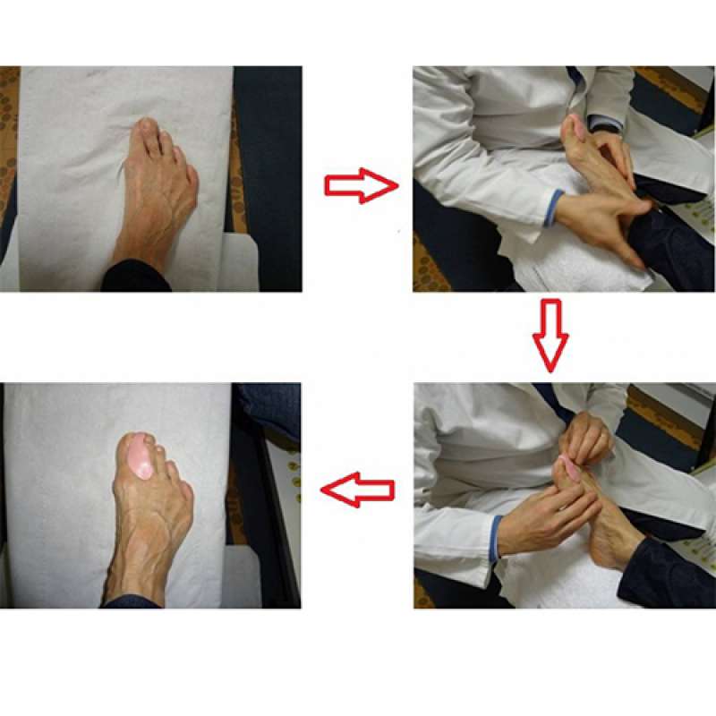 Ortesi in silicone per protezione e divaricazione deformità del piede