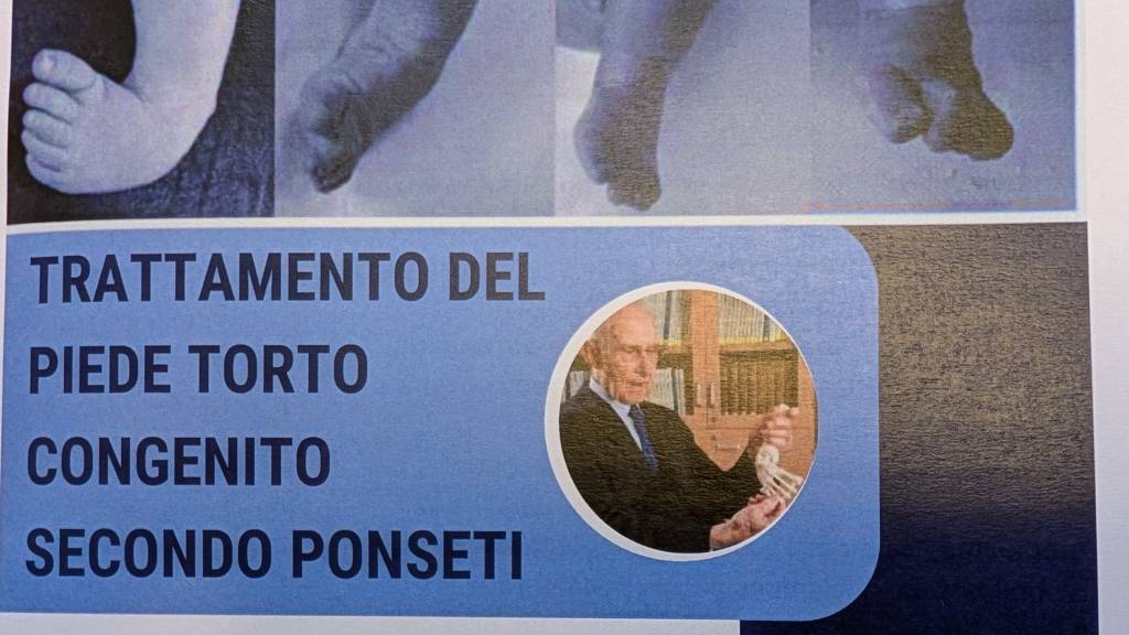 CONVEGNO DEL 26-27 FEBBRAIO SUL TRATTAMENTO DEL PIEDE TORTO SECONDO PONSETI