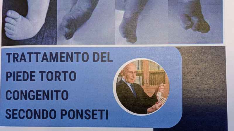 CONVEGNO DEL 26-27 FEBBRAIO SUL TRATTAMENTO DEL PIEDE TORTO SECONDO PONSETI
