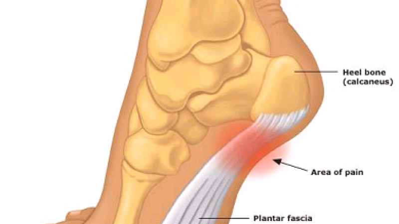 FASCITE PLANTARE? i plantari possono risolverla