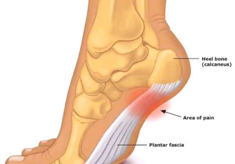 FASCITE PLANTARE? i plantari possono risolverla