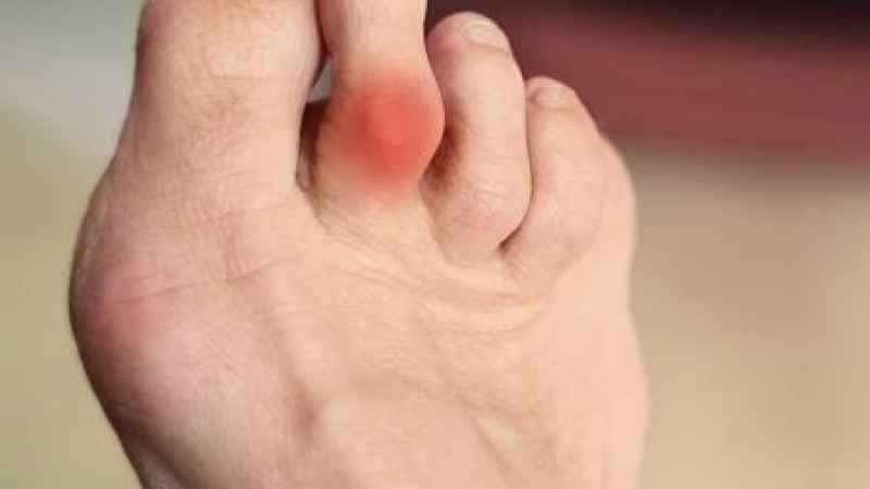 Le deformità delle dita del piede: cause, sintomi e trattamenti