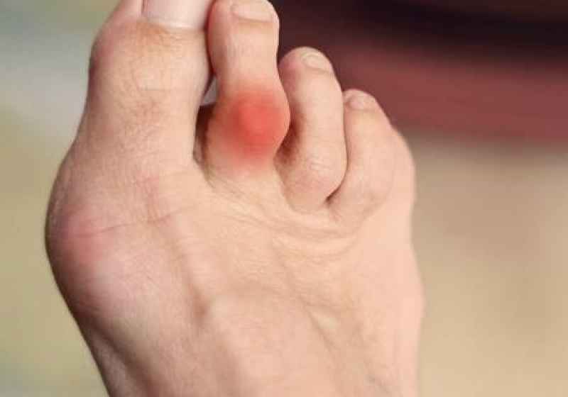 Le deformità delle dita del piede: cause, sintomi e trattamenti