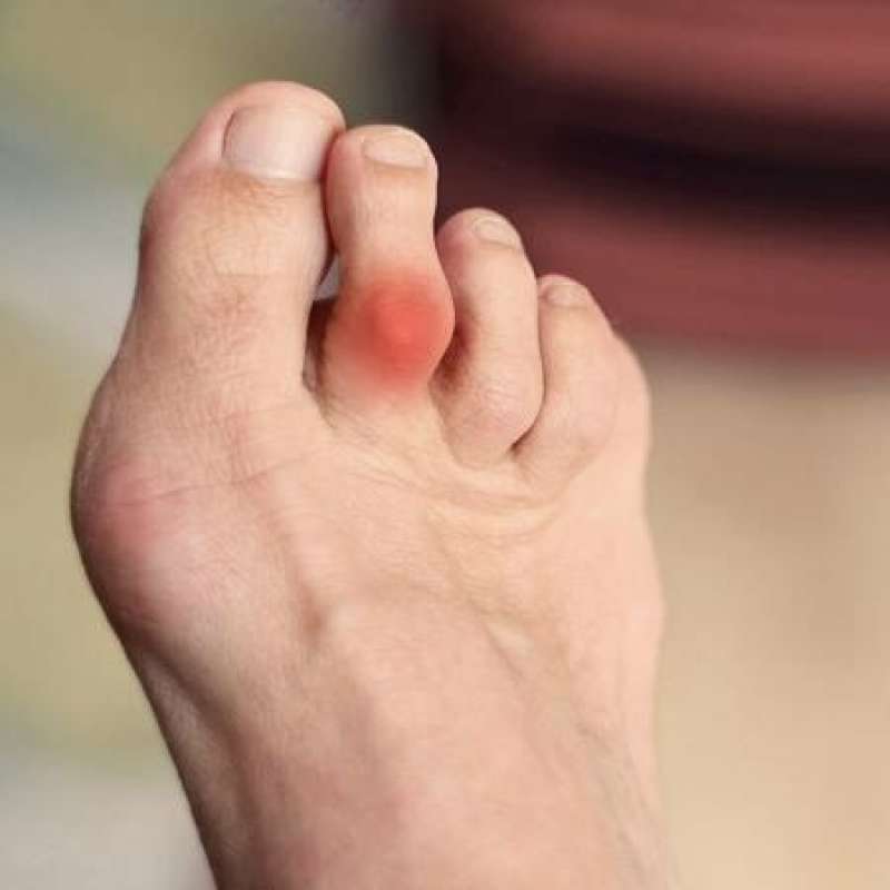 Le deformità delle dita del piede: cause, sintomi e trattamenti