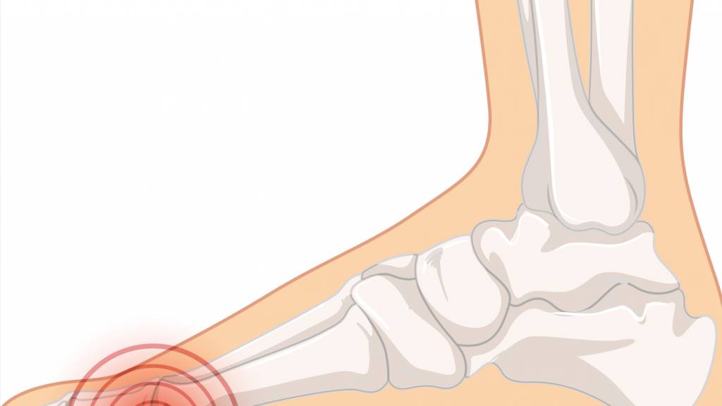 La Metatarsalgia: Tutto Quello che Serve Sapere per Affrontarla