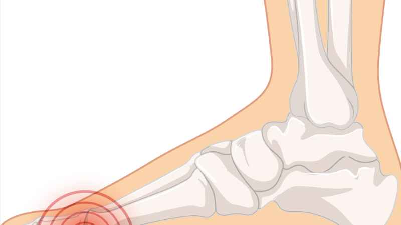 La Metatarsalgia: Tutto Quello che Serve Sapere per Affrontarla