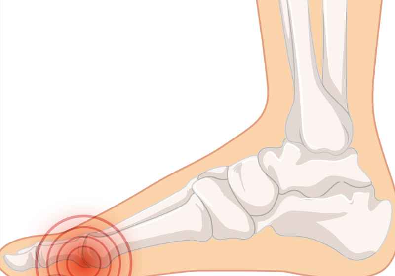 La Metatarsalgia: Tutto Quello che Serve Sapere per Affrontarla