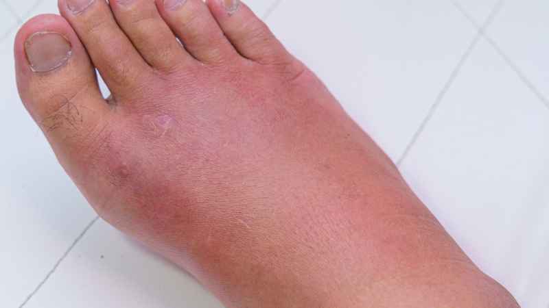 Il linfedema: cause, sintomi e trattamento