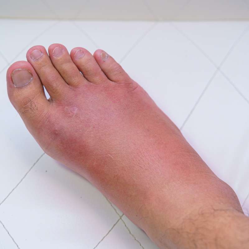 Il linfedema: cause, sintomi e trattamento